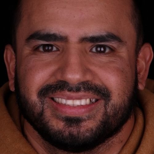 Testimonials porcelain veneers in mexico 11